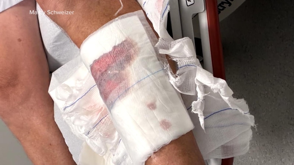 WATCH: Connecticut man speaks out after shark attack in the Bahamas