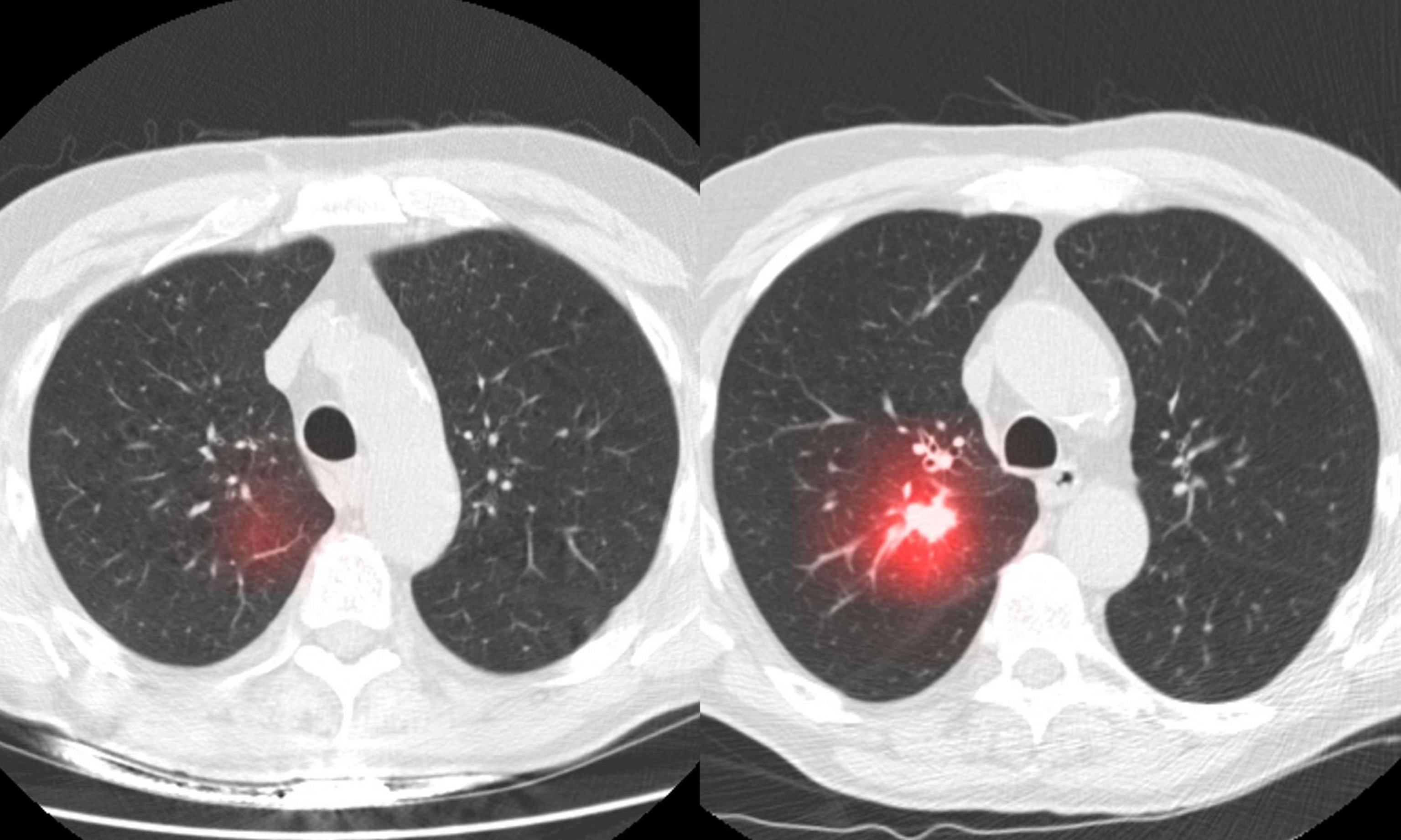 PHOTO: CT scans show the accuracy of Sybil -- the AI tool developed by MIT and Mass Gen -- at detecting early lung cancer.