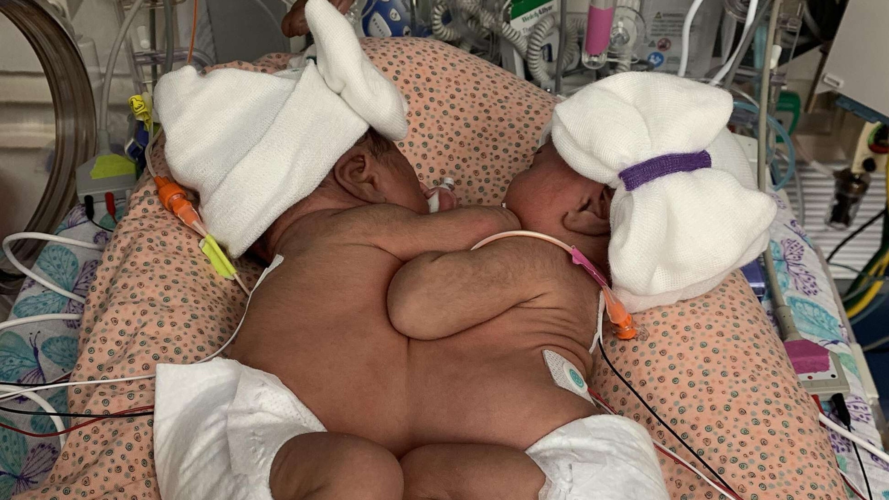 2nd formerly conjoined twin goes home, reunites with sister - ABC News