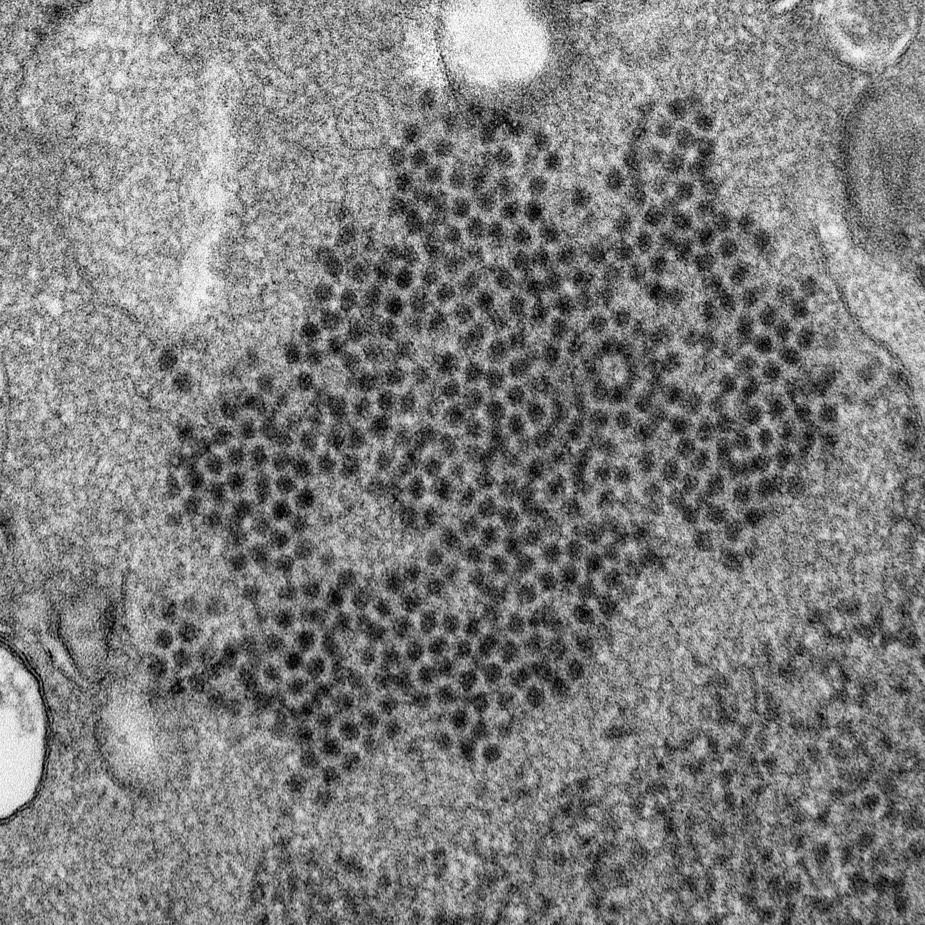 PHOTO: This 2014 file electron microscope image made available by the Centers for Disease Control and Prevention shows numerous, spheroid-shaped enterovirus-D68 (EV-D68) virions.