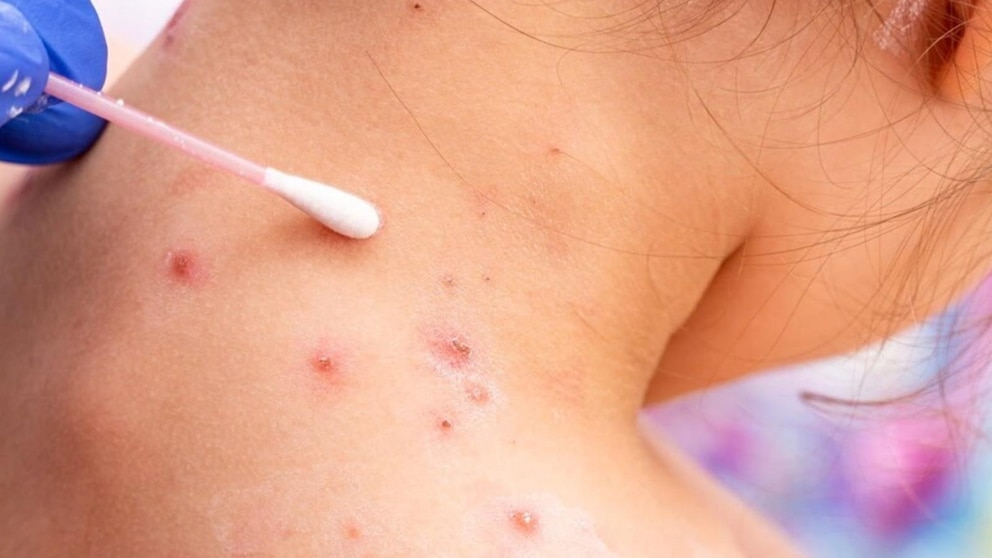 Video Unvaccinated child dies of measles amid Texas outbreak