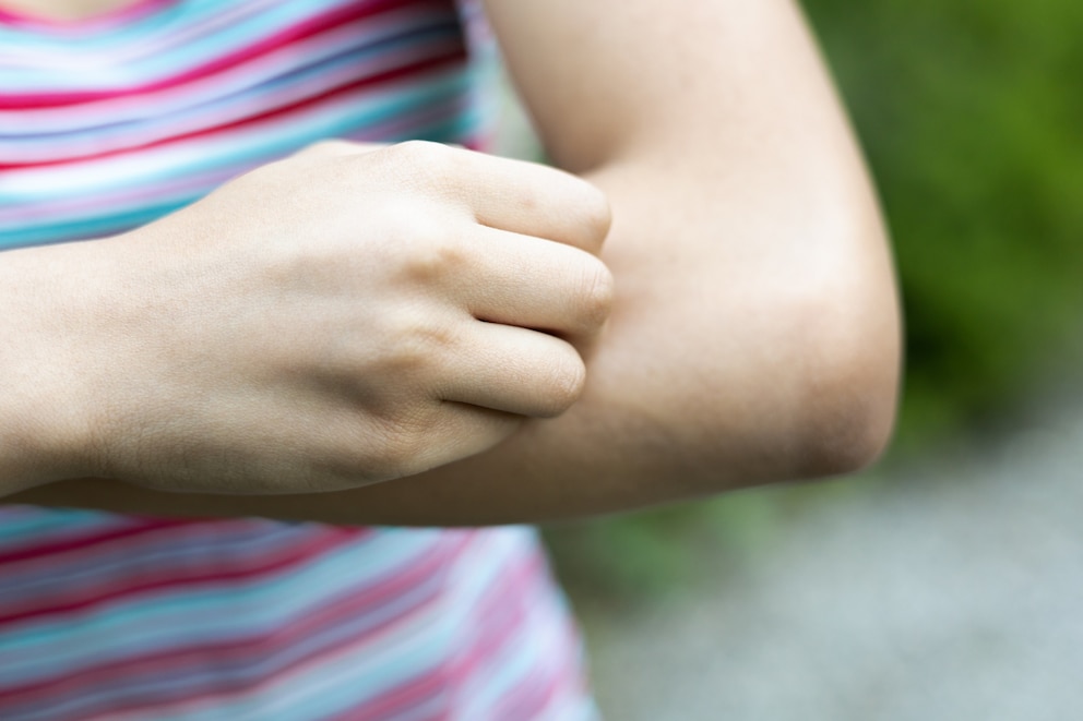 PHOTO: A person itches a bite in an undated stock photo. 