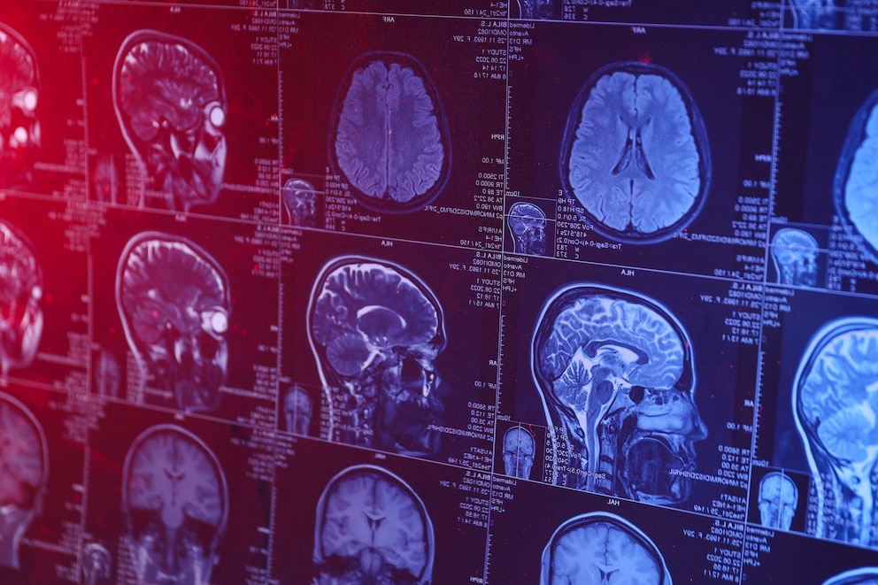 PHOTO: MRI or magnetic resonance imaging of the head and brain. Close up