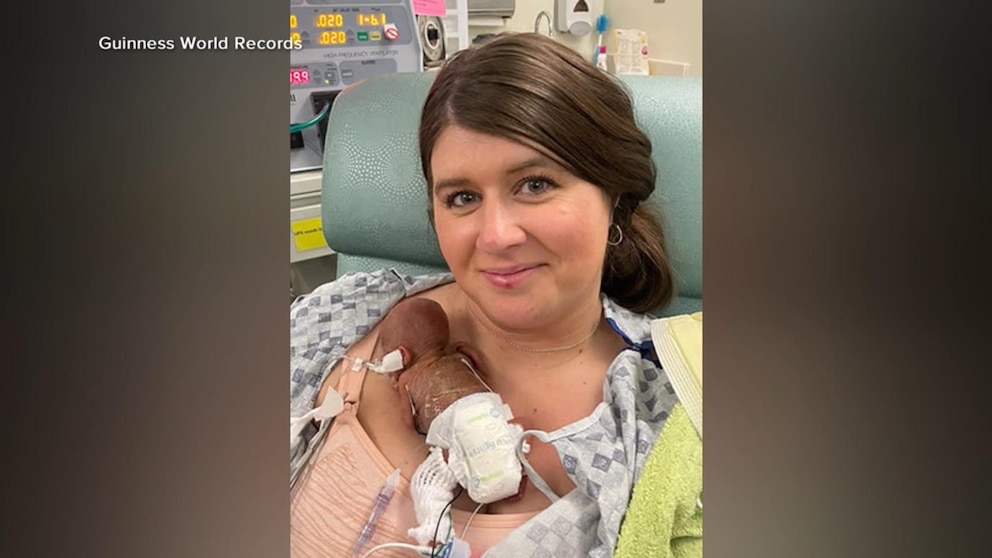 US Baby Born At 21 Weeks Sets Guinness Prematurity Record