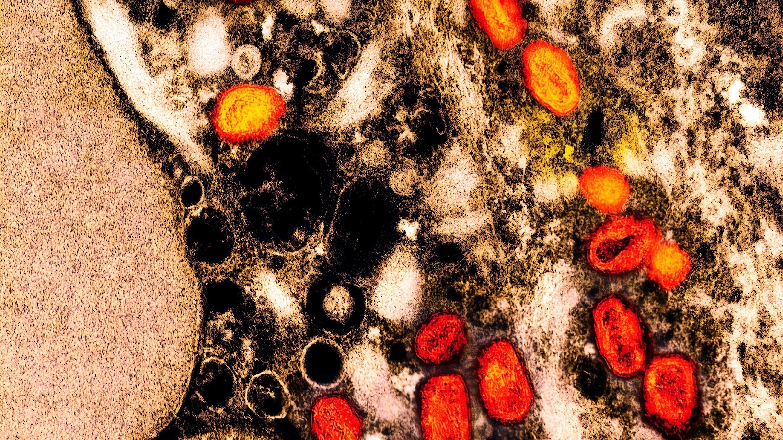 More than half of mpox patients in 2022 outbreak experienced lasting physical effects: Study