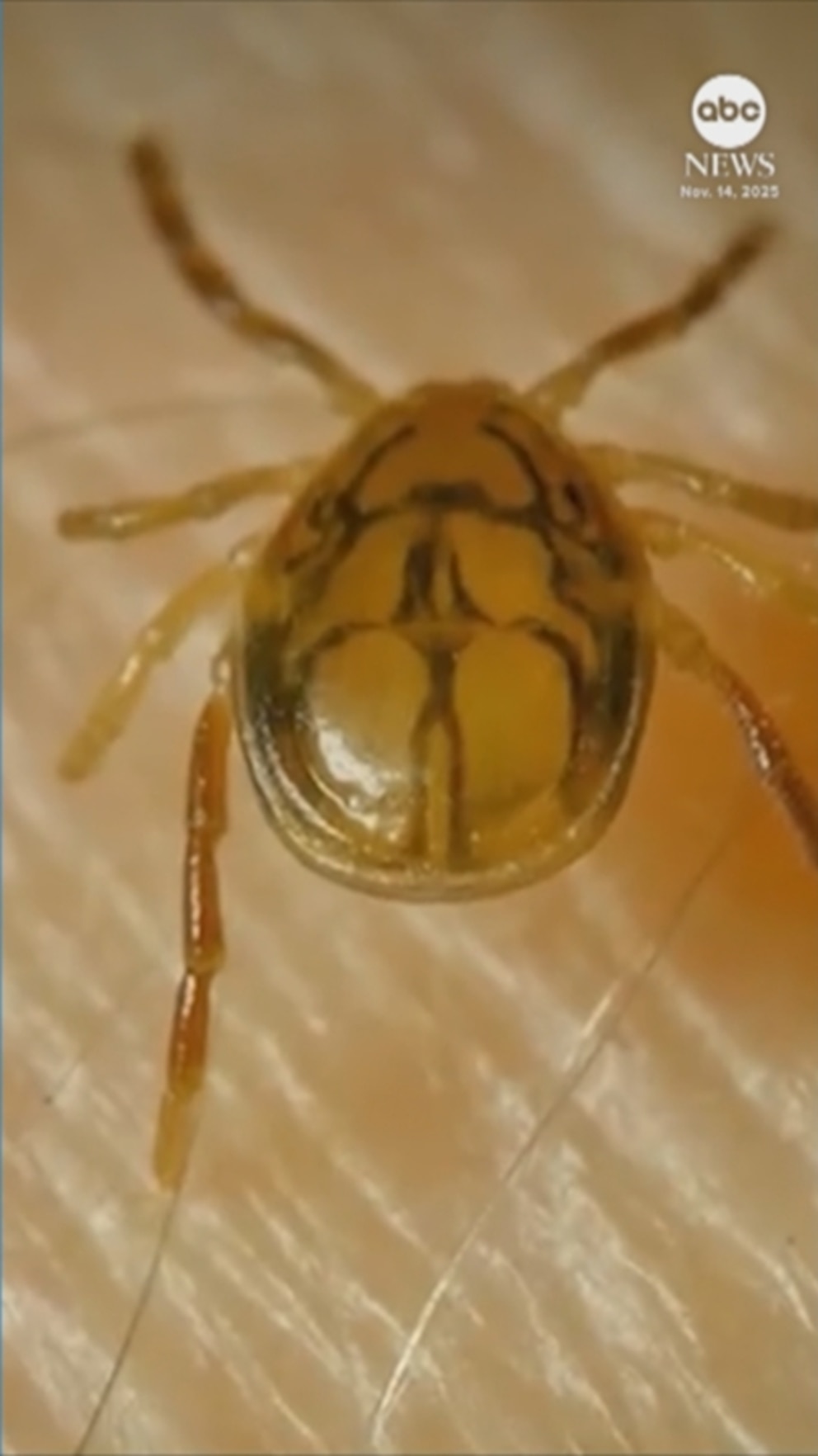 WATCH: NJ man believed to be 1st known death from tick bite linked to red meat allergy