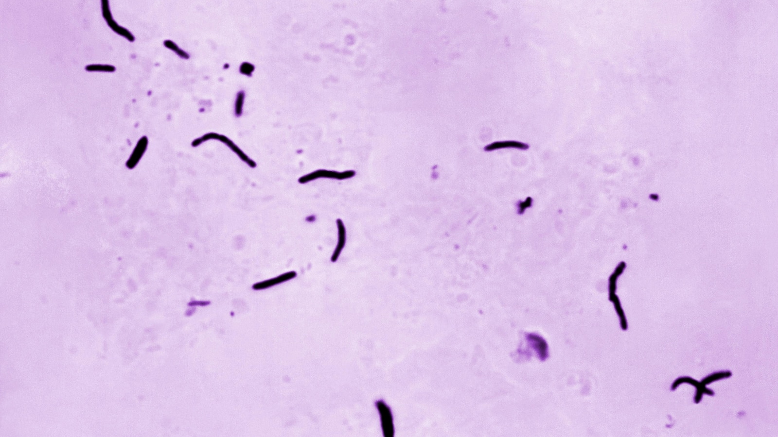 Global tuberculosis diagnoses rise to a record, but deaths fall, WHO reports